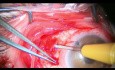 Kombinierte Ahmed-Klappenimplantation und Verschluss des Makulalochs