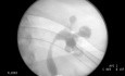 Perkutane Nephrolithotomie: Zugang zum Nierenhohlsystem