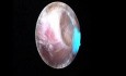 Endometriumablation durch die Hysteroresektion