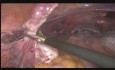 Totale laparoskopische Hysterektomie bei einem 24 Wochen alten fetalen Uterusmyom