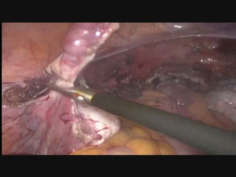 Totale laparoskopische Hysterektomie bei einem 24 Wochen alten fetalen Uterusmyom