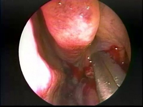 Hypoplastischer Sinus maxillaris Typ 2 - endoskopische Behandlung