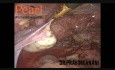 Entfernung von Knötchen im rektovaginalen Septum mit totaler laparoskopischer Hysterektomie