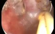 Adenomyose- die Endometriumablation