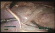 Ein großes Myom (intraligamentär) im Ligamentum latum uteri