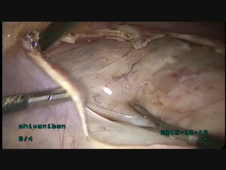 Ein großes Myom (intraligamentär) im Ligamentum latum uteri