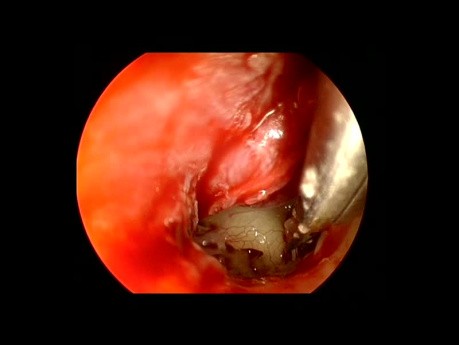 Endoskopische Stapedotomie