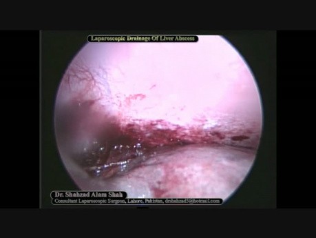 Laparoskopische Drainage des Leberabszesses
