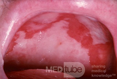 Gutartiges Schleimhautpemphigoid