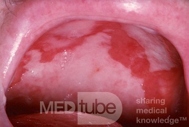Gutartiges Schleimhautpemphigoid