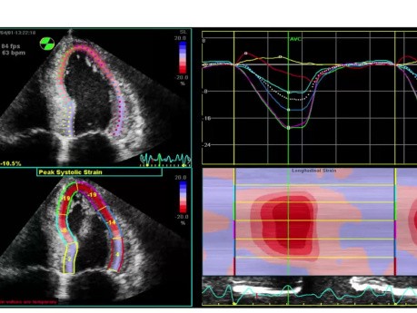 Echokardiographische Merkmale systemischer Erkrankungen - Eine fallbasierte Diskussion.