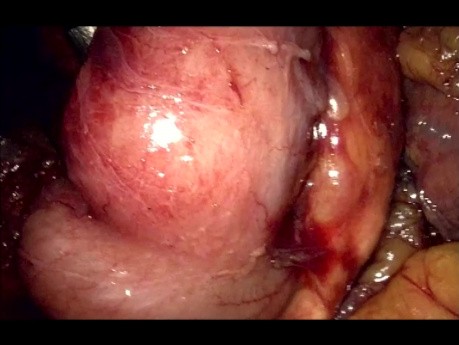 Laparoskopische Whipple-Resektion – Teil 1