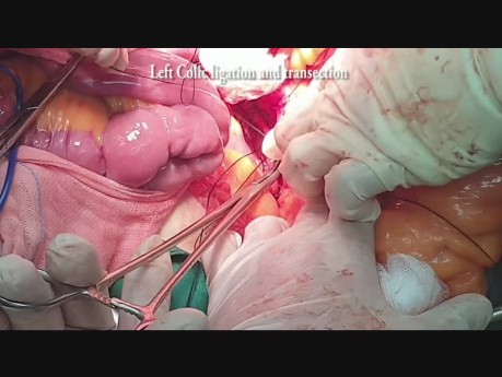 Schonung der Arteria rectalis superior