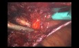 Laparoskopische ventrale Hernienreparatur mittels TAPP kombiniert mit laparoskopischer Leistenhernienreparatur mittels TAPP (mit Anmerkungen)