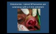 Rhinoplastik-Klassen - Nasendeformität