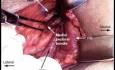 Axilläre Lymphknotendissektion (ALND)