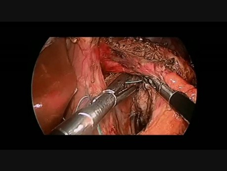 Laparoskopische Heller's Kardiomyotomie kompliziert durch Perforation der Ösophagusschleimhaut