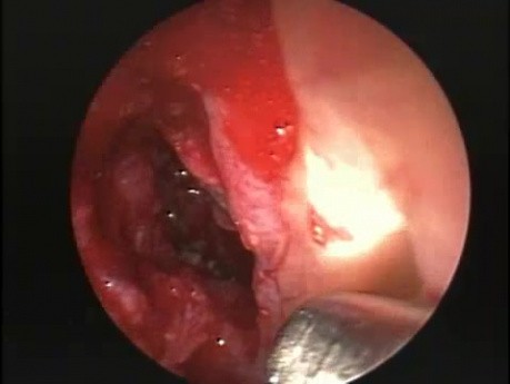 Zugang zur Keilbeinhöhle durch die Vorderwand - Endoskopie