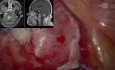 Resektion eines metastatischen Tumors in der rechten Kleinhirnhemisphäre
