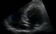 Echofall bei hypertropher Kardiomyopathie
