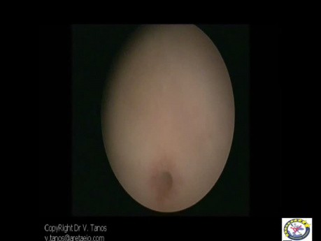 Hysteroskopie