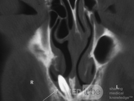 Zahn ragt durch den Boden der Nasenhöhle [CT-Scan]