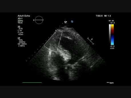 Ventrikuläre Septumruptur nach dem anterioren Myokardinfarkt