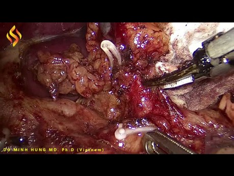 Laparoskopische Exzision von suprapankreatischen Lymphknoten aufgrund von Magenkrebs