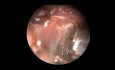 Endoskopische Resektion des Kavernoms der Fossa infratemporalis 
