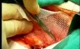 Lichtenstein Vorgehen - Hernienreparatur