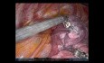 Pulmonale S1-3-Trisegmentektomie des linken Oberlappens