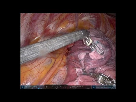 Pulmonale S1-3-Trisegmentektomie des linken Oberlappens