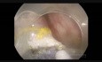 Endoskopische Submukosadissektion gestielter Sigmoid-Polypen - Behandlung den großen Gefäßen der Stiel des Polyps