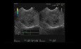 Endoskopischer Ultraschall eines pseudopapillären Tumors der Bauchspeicheldrüse