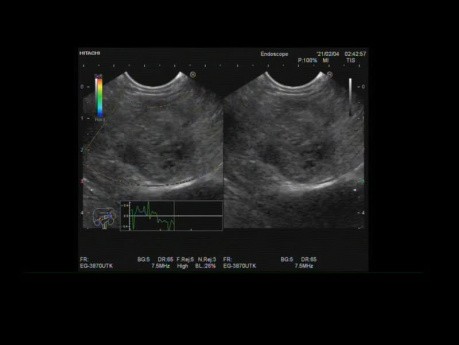 Endoskopischer Ultraschall eines pseudopapillären Tumors der Bauchspeicheldrüse