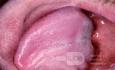 Parese des Nervus hypoglossus