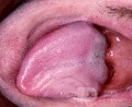 Parese des Nervus hypoglossus