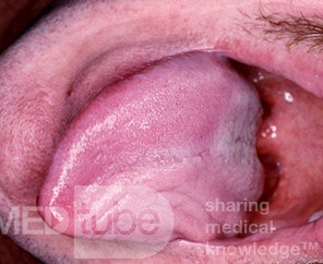 Parese des Nervus hypoglossus